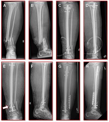 Individualized Determination of the Mechanical Fracture Environment After Tibial Exchange Nailing—A Simulation-Based Feasibility Study